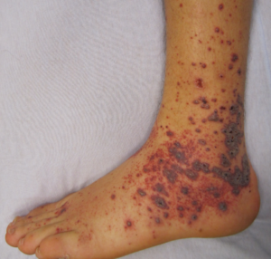 meningococcal rash